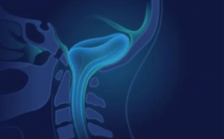 Chiari Dekompresyon Cerrahisi ve Siringomiyeli