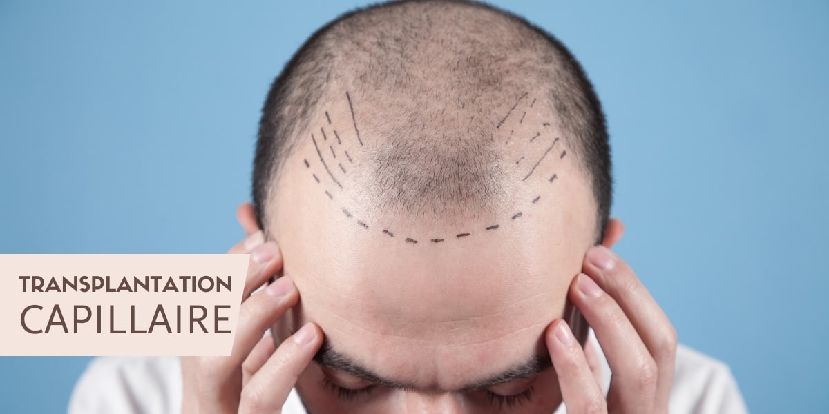 Slider - Transplantation capillaire