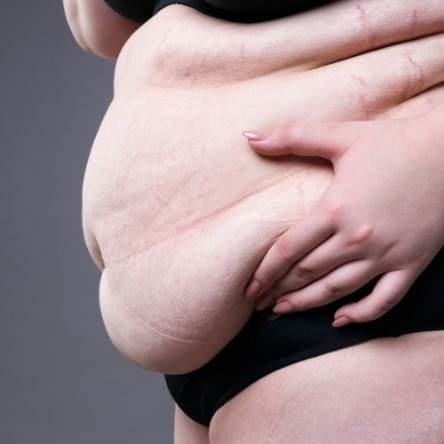 Bariatric Surgery