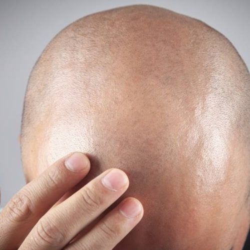 Hair Transplant